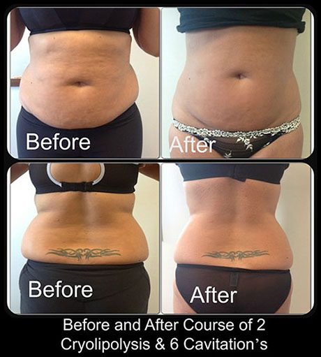 before-after-3-d-lipo-3